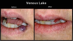 Keywords Venous lake, Pulsed dye laser, Nd . . Venous lake treatment at home
